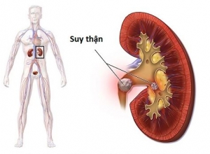  Bệnh suy thận có lây không? Những con đường lây nhiễm nguy hiểm bạn cần biết